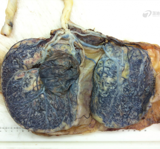双叶胎盘伴脐带插入