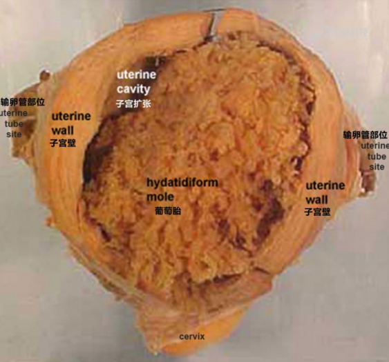 葡萄胎hydatidiform_mole
