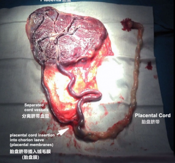胎盘脐带placenta_velamentous_cord